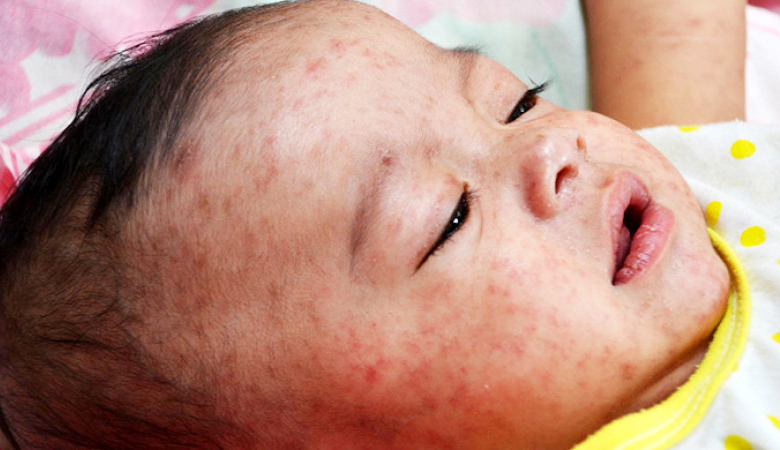 গোপালগঞ্জে হামের উপসর্গ নিয়ে শিশুর মৃত্যু, ছড়িয়েছে আতঙ্ক-উদ্বেগ