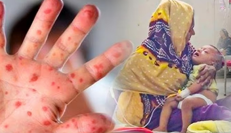 হাম ও হামের উপসর্গ নিয়ে ১১ শিশুর মৃত্যু