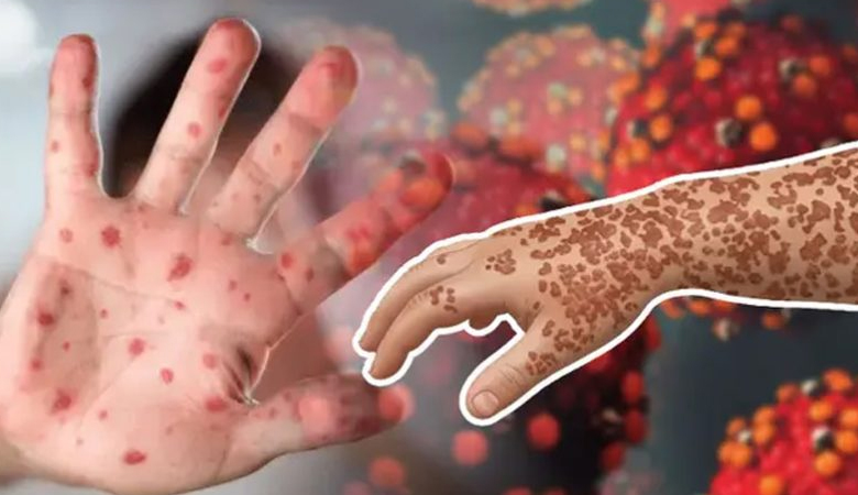 দেশে হাম ও হামের উপসর্গ নিয়ে আরো ৫ শিশুর মৃত্যু