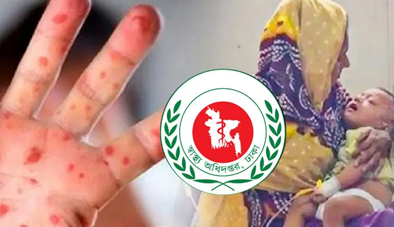 হাম ও হামের উপসর্গ নিয়ে আরো ৪ শিশুর মৃত্যু