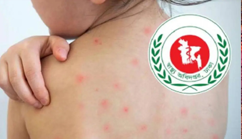 হাম ও হামের উপসর্গ নিয়ে আরো ৪ শিশুর মৃত্যু