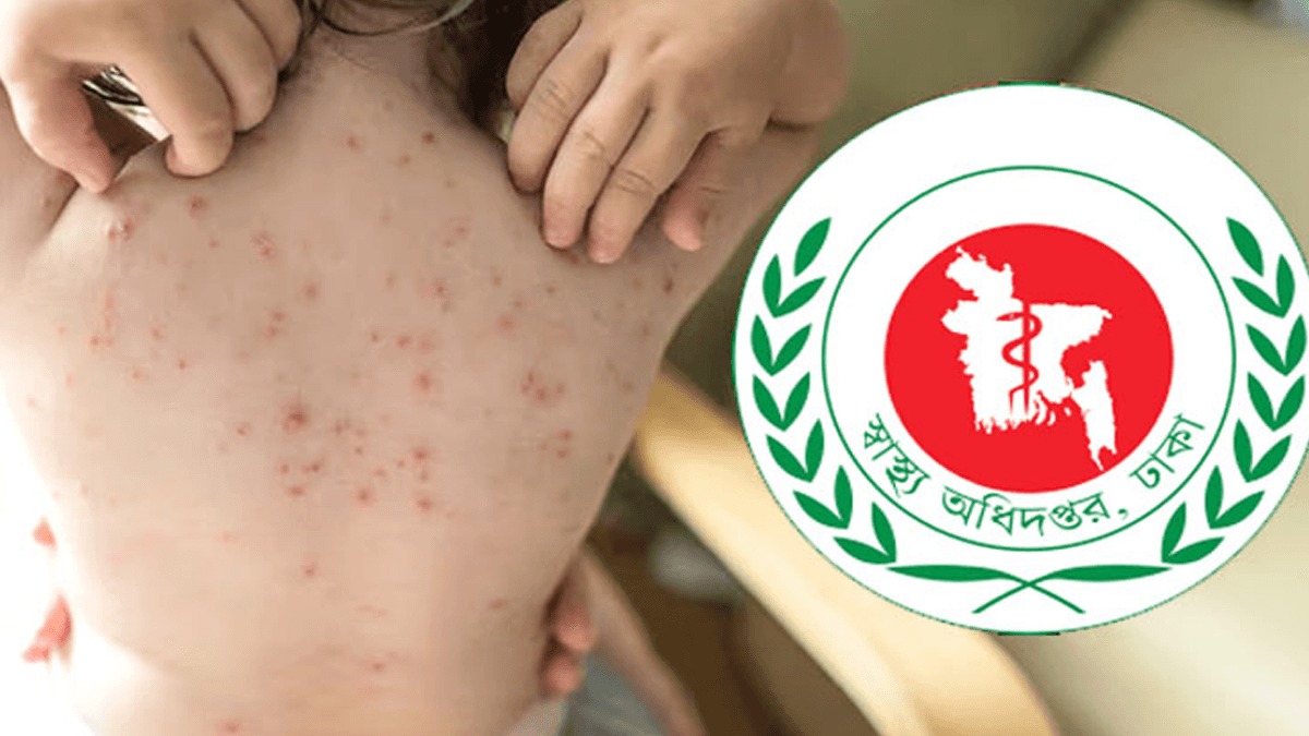হামের উপসর্গ নিয়ে আরো ৫ শিশুর মৃত্যু