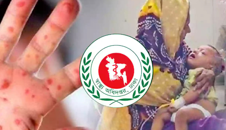 হাম ও হামের উপসর্গ নিয়ে আরো ৭ শিশুর মৃত্যু