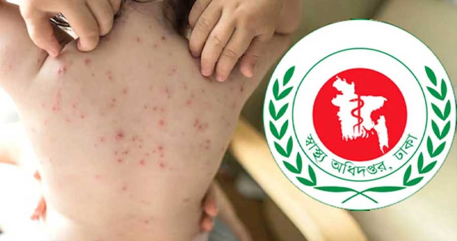 হাম ও উপসর্গে বাড়ছে মৃত্যু, ২৪ ঘণ্টায় ৭ প্রাণহানি