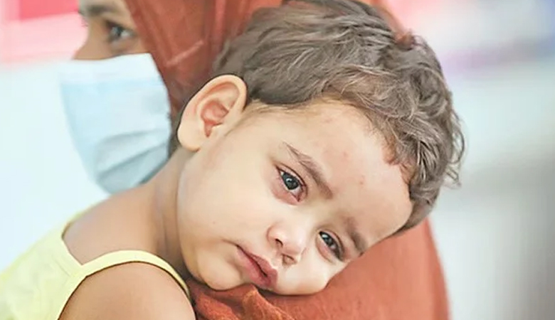 হামের উপসর্গ নিয়ে প্রাণ গেলো আরো ৫ শিশুর