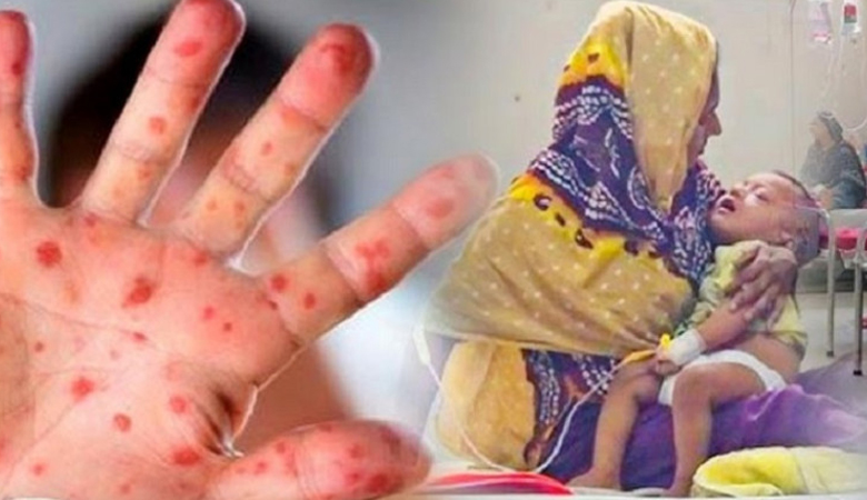 হামের উপসর্গ নিয়ে আরো ৫ জনের মৃত্যু